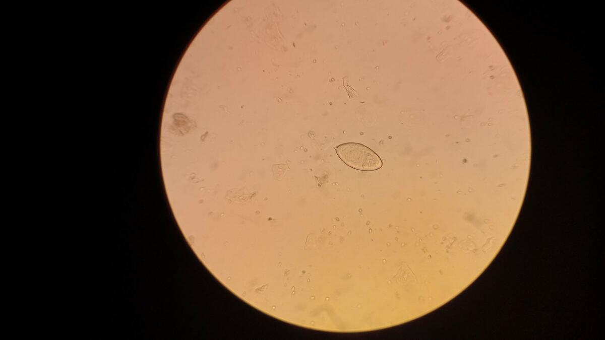 Schistosoma Haematobium egg in semen.