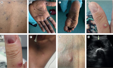 Skin and soft tissue manifestations of monkeypox. Credit: Lancet Infectious Diseases