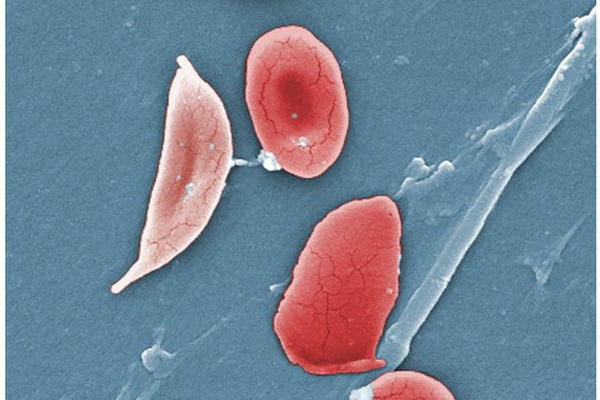 Sickle Cells OpenStax College, CC BY 3.0 <https://creativecommons.org/licenses/by/3.0>, via Wikimedia Commons