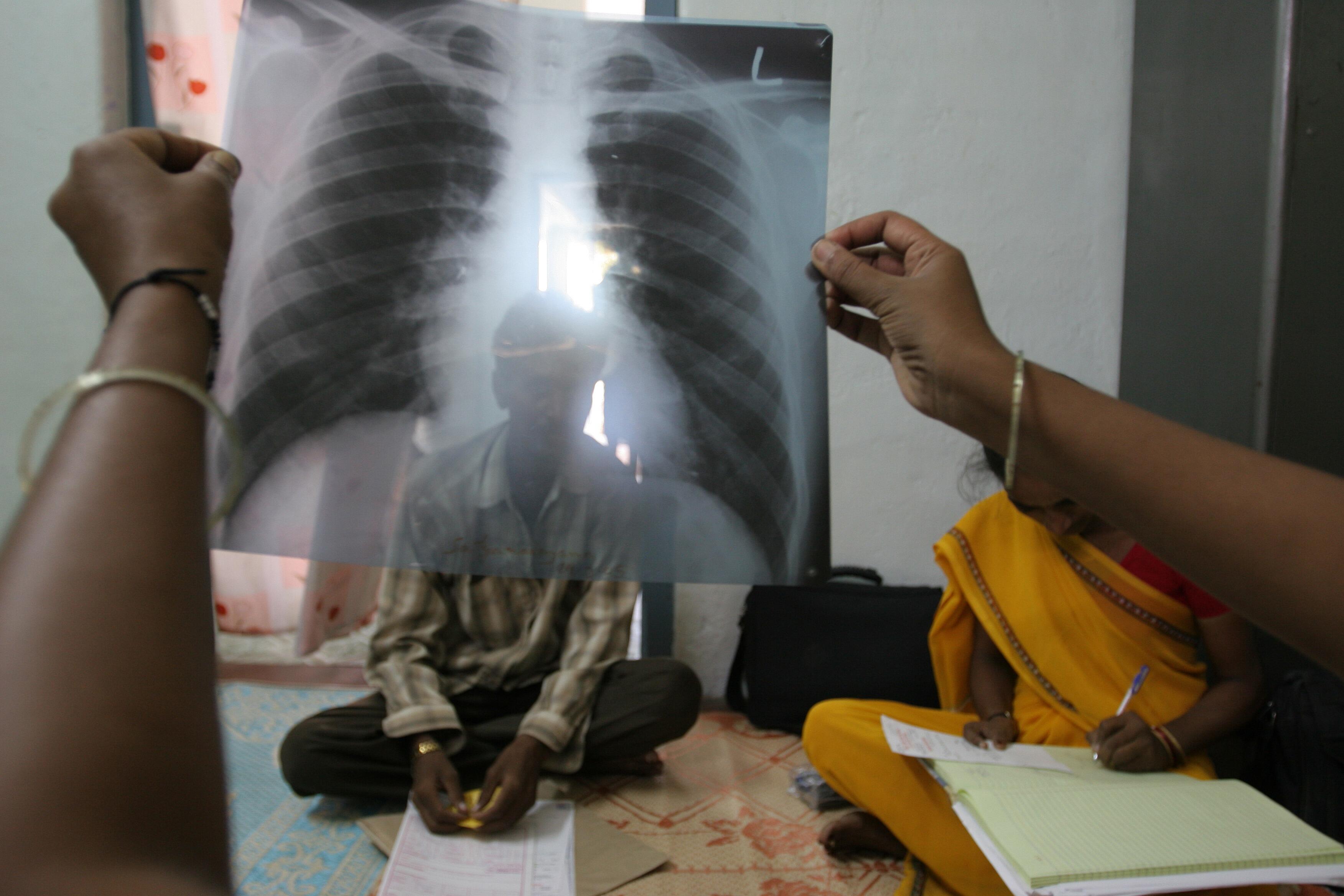 © Flickr Creative commons - Gates Foundation World TB Day © Flickr Creative commons - Gates Foundation World TB Day