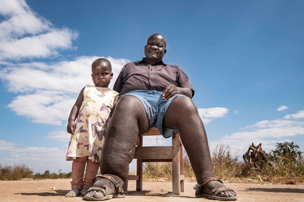 Laitchani Levson developed LF in 2001. His granddaughter Elfrieda is pictured next to his swollen leg - Photo credit: Simon Townsley/Daily Telegraph Laitchani Levson developed LF in 2001. His granddaughter Elfrieda is pictured next to his swollen leg - Photo credit: Simon Townsley/Daily Telegraph