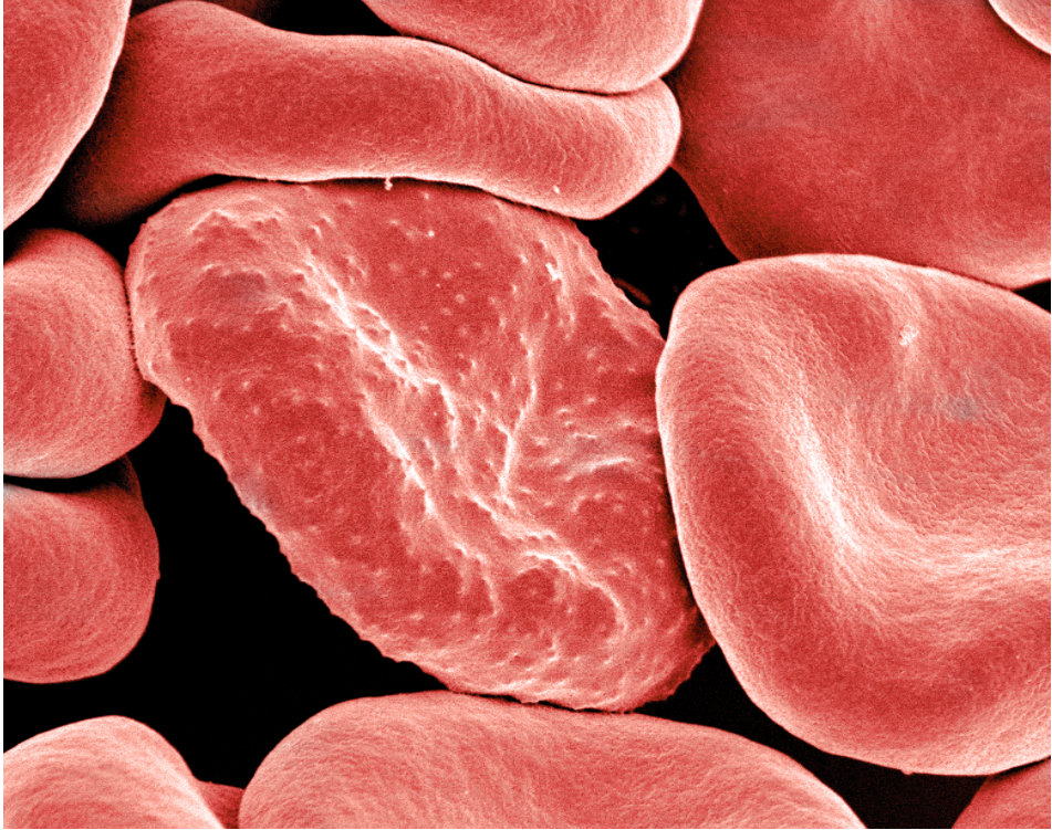 centre: a malaria parasite infested blood cell