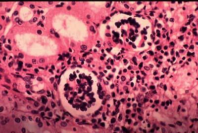 Visceral leishmaniasis Visceral leishmaniasis