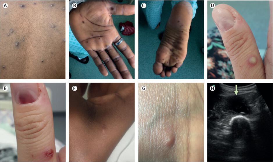 Skin and soft tissue manifestations of monkeypox. Credit: Lancet Infectious Diseases Skin and soft tissue manifestations of monkeypox. Credit: Lancet Infectious Diseases