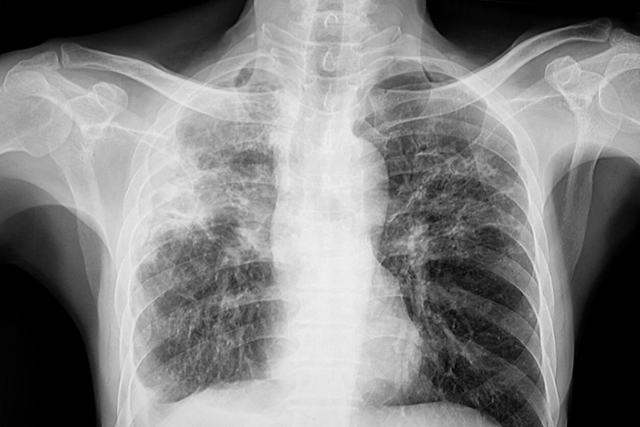 Lungs affected by TB