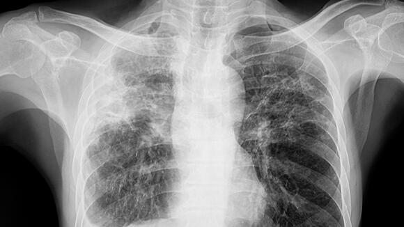 Lungs affected by TB